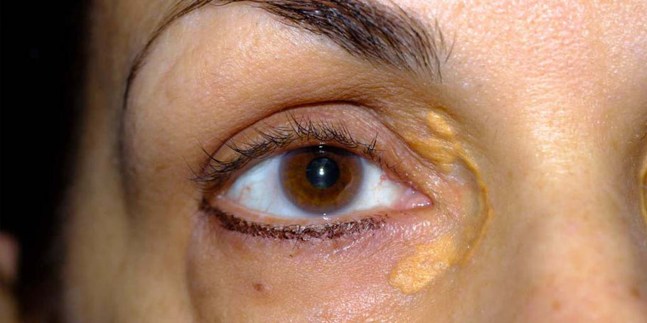 Have you noticed yellowish bumps around your eyes? They can be Xanthelasma