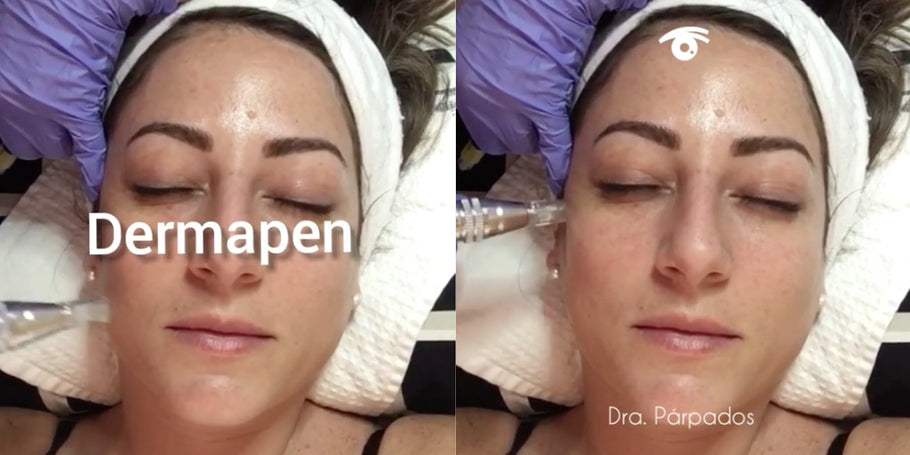 Dra. Parpados resumes consultations and applies treatment with Dermapen