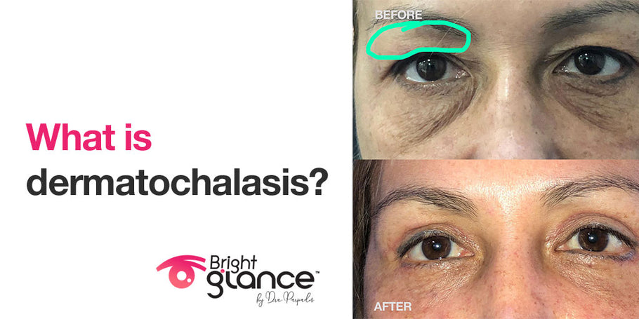 Ptosis and dermatochalasis what you should know about them